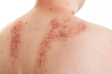 Marks on the skin of a man's back after a massage. Concept of improper massage, bruising and skin...