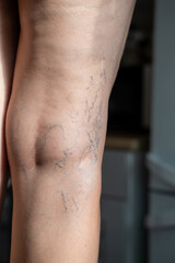 Naklejka premium A mature woman is taking care of her legs. Back view of knee - Popliteal fossa. Foot care. Venous disease - varicose veins.