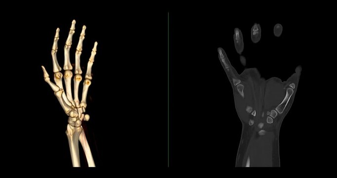 CT scan footage showing a detailed 3D rendering of a normal human hand. The scan highlights clear bone structures, joints, and soft tissues.