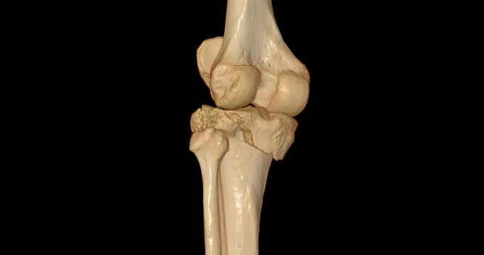 CT scan footage of Knee joint displaying a clear fracture of the tibia  bones.Perfect for medical education, diagnostic materials, or healthcare-related visual content.