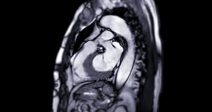 Real-time MRI footage of a healthy human heart, showing clear details of normal cardiac function. Ideal for medical and educational use, highlighting the heart's ventricles, atriam, and vessels .