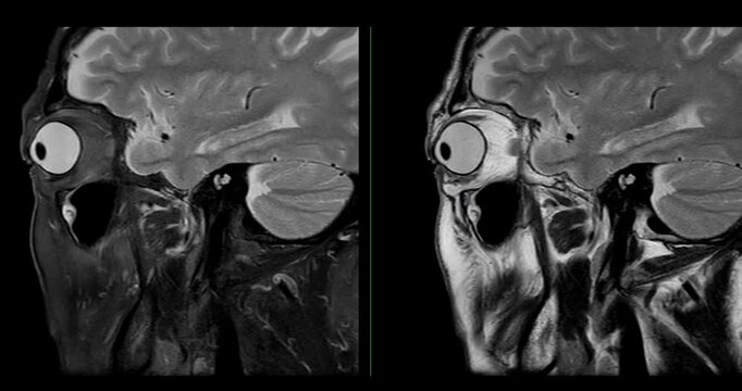 High-Resolution MRI Scan of Paranasal Sinuses for Medical Diagnosis and Anatomical Study.