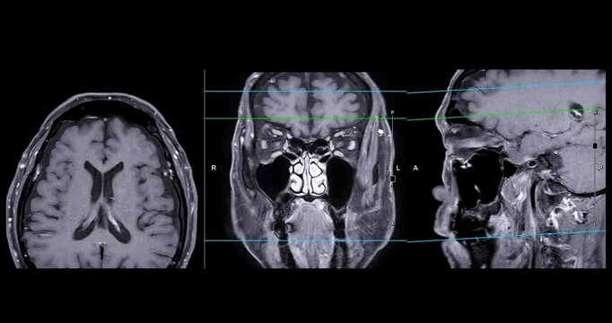 High-Resolution MRI Scan of Paranasal Sinuses for Medical Diagnosis and Anatomical Study.