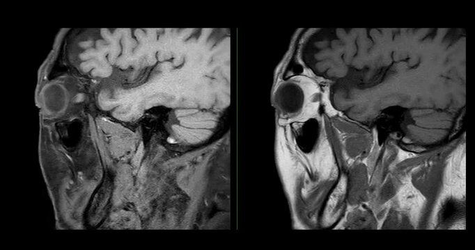 High-Resolution MRI Scan of Paranasal Sinuses for Medical Diagnosis and Anatomical Study.