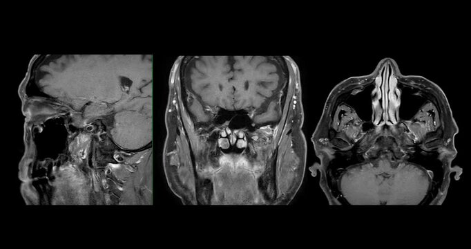High-Resolution MRI Scan of Paranasal Sinuses for Medical Diagnosis and Anatomical Study.