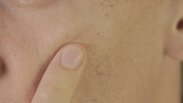 Scars after acne on mans face skin. Problem skin treatment. Close up.