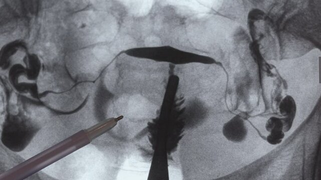 Doctor examining X-ray image of Hysterosalpingography (HSG). MRI with contrast agent. Uterine tubes, analysing female reproductive system. Infertility treatment.