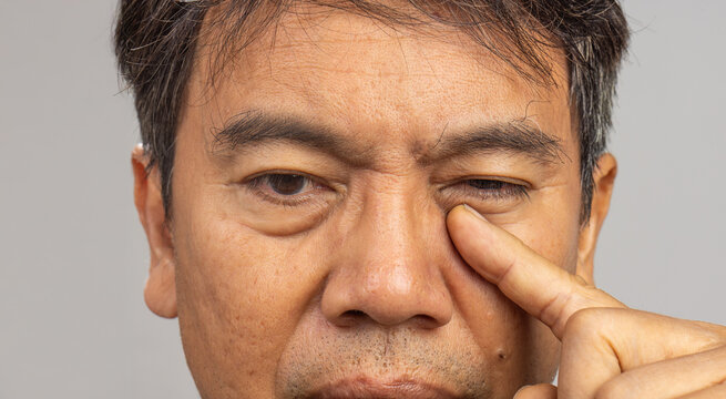 Senior man eye strain after for long stretches at computer or digital screens.