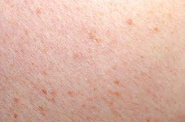 Fototapeta premium Moles on the skin or pigment spots with nevi.