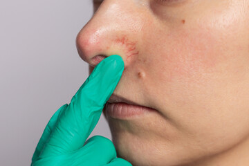 Close up doctor in green gloves examining the inflamed blood vessels on the nose of a young woman...