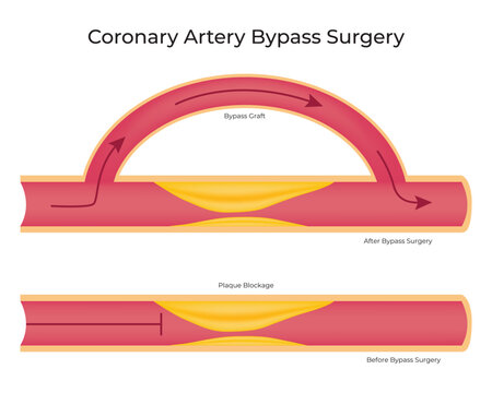Coronary Artery Bypass Surgery Science Design Vector Illustration Diagram