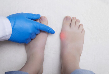 Hallux valgus, deformation of the big toe. Orthopedic doctor examines the bone on the foot,...