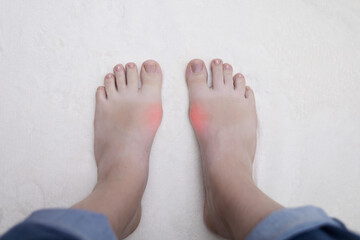 Hallux valgus, deformation of the big toe. Orthopedic doctor examines the bone on the foot,...