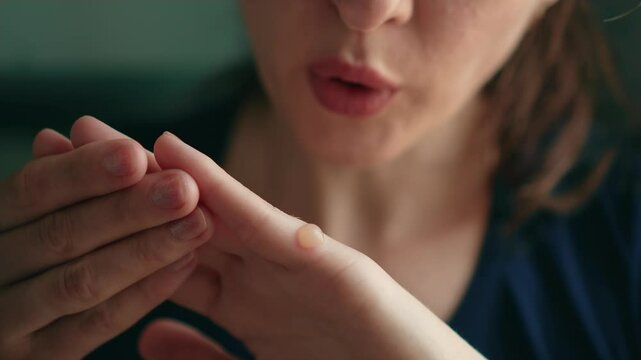 Woman with damaged finger skin sitting at kitchen and blowing to blister. Thermal burn on finger with blister. Burn treatment concept, degree of burn, close up.