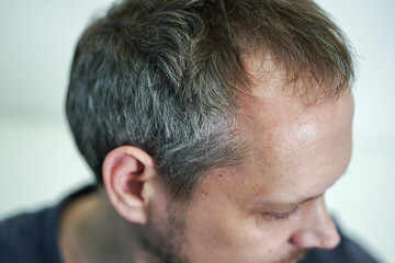 Fototapeta premium Baldness on the head of a middle-aged man. Hair loss.
