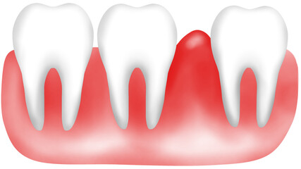  teeth and Swollen red gum due to gum disease