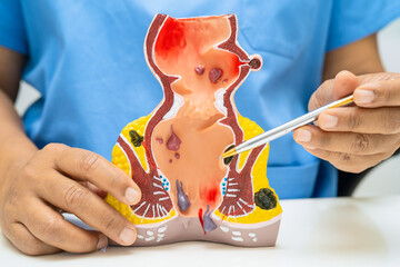 Asian doctor with rectum and hemorrhoid human anatomy model at hospital, inflamed vascular...
