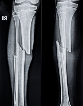 X ray image of shaft of tibia and fibula fracture 
