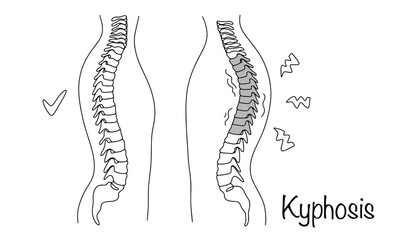 Kyphosis
