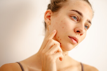 A young woman inspects her skin in natural light. Concept of acne therapy, scars, inflammation.