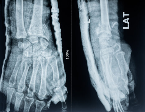 X ray showing  fracture in styloid process of radius bone 