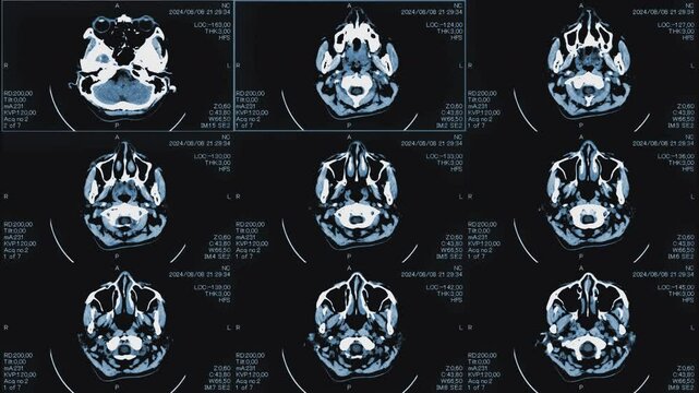 Magnetic resonance images of the brain, MRI of the brain, of a patient with multiple vascular infarctions, front view, monochrome animation Seamless Loop. 