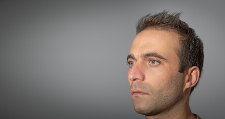 Caucasian man after hair transplantation.