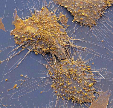 Bone cancer cells, SEM