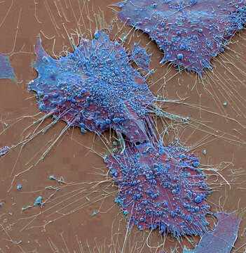 Bone cancer cells, SEM