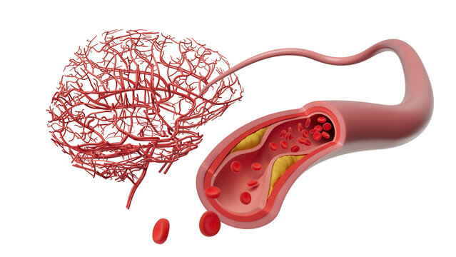 Atherosclerosis and vascular dementia connection, conceptual illustration