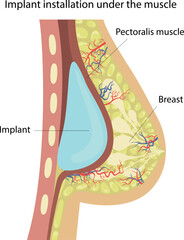 Breast augmentation with implants.