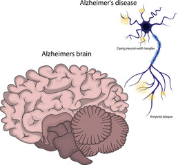 brain with Alzheimers disease.