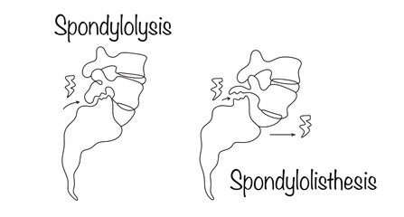 Obraz premium Spondylolysis. Spondylolisthesis