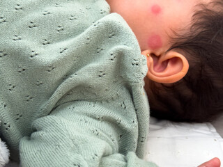 Baby Sleeping with Two Mosquito Bites on Her Face