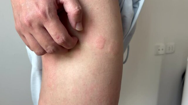 Young asian man has allergic skin rash on his legs from itchy dry skin eczema dermatitis insect bites