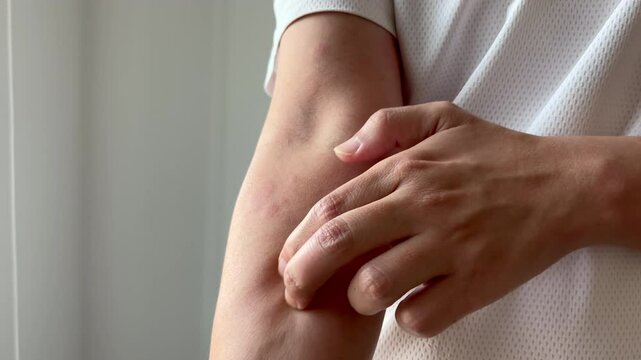 Young asian man itching and scratching on arm from allergic itchy dry skin eczema dermatitis insect bites