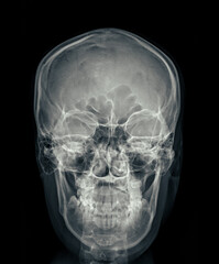 X-ray image of the skull in AP (anterior-posterior) view, displaying clear bone structure with no visible abnormalities.