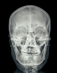 X-ray image of the skull in AP (anterior-posterior) view, displaying clear bone structure with no visible abnormalities.