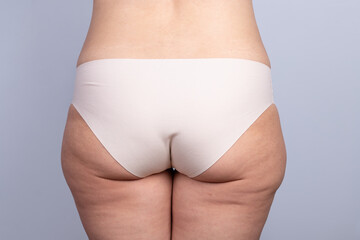 Rear close-up view of the buttocks of a slightly overweight woman with cellulite and stretch marks...