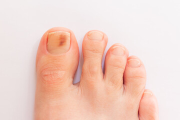a close-up photo of a woman's foot with a damaged nail plate on her toe after wearing uncomfortable...