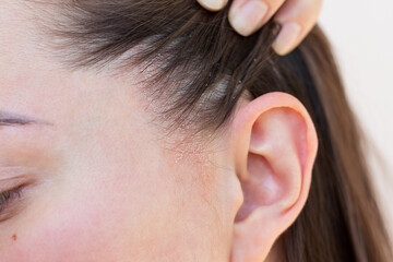 A young Caucasian woman suffering from seborrheic dermatitis in the acute stage. A woman showing dandruff on the scalp. Dermatology and trichology.