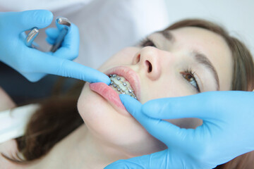 Correction of braces. Girl at an orthodontist's appointment. Close-up. An open mouth. Modern dentistry. Correction of tooth growth and bite.