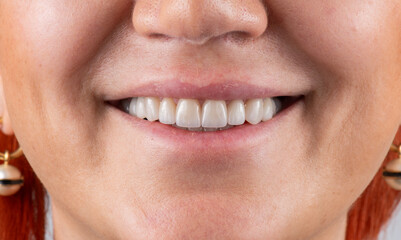 Obraz premium dental crowns and veneers