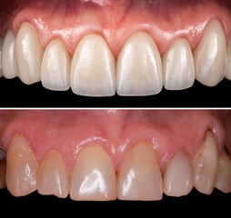 dental crowns and veneers