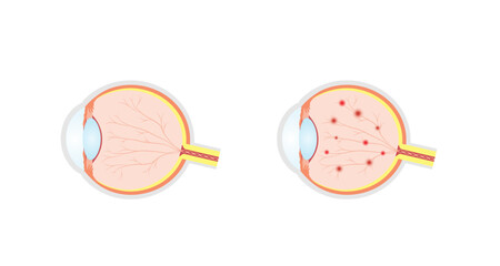 Diabetic retinopathy. Healthy eye and damaged eye. Retinal damage, vision loss. Diabetes disease. Hemorrhages, aneurysms, abnormal blood vessels. Scientific vector illustration.