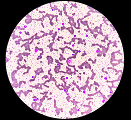 Thrombocytosis blood smear, present abnormal high platelet count analyze by microscope
