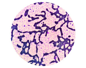 Thrombocytosis blood smear, present abnormal high platelet count analyze by microscope