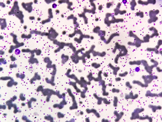 Thrombocytosis blood smear, present abnormal high platelet count analyze by microscope