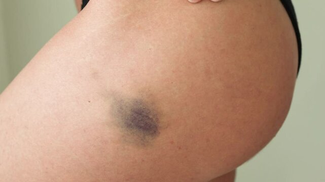 Large blue bruise on a woman's leg
