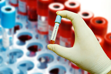 Blood Sample Collection in a Test Tube for Medical Testing and Research - Testosterone Test -...